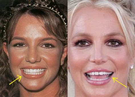 britney spears teeth|Britney Spears Full Teeth Transformation Is A Shocking Sight